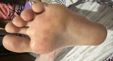 Çocuklarda artan el ayak ağız hastalığına dikkat: Uzmanlar tatilde ortak kullanılan alanlara karşı uyardı