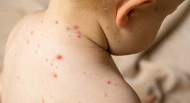 Kızamık hastalığı yeni salgın mı?