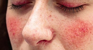 Sıcaklar 'gül hastalığı'na dikkat!