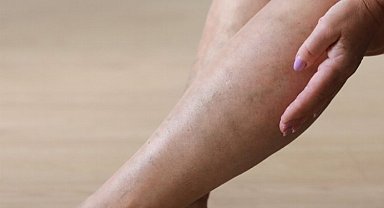 Sıcak havalar varis şikayetlerini de arttırıyor!