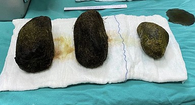 Midesinden 2 kilo saç çıktı!