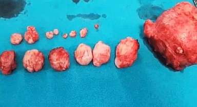 Rahminden 16 tümör çıktı!
