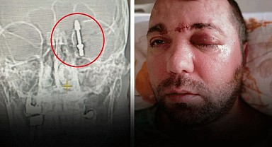 Bursa'da şok olay! İmplant tedavisinde vida beynine saplandı