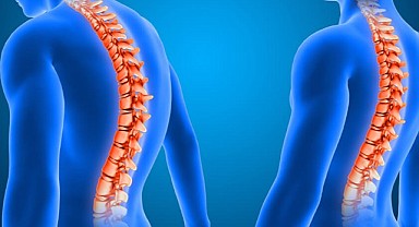 Skolyozda ameliyat kararını eğriliğin açısı belirliyor