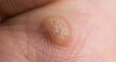 Ayakta ve genital bölgede çıkan siğile dikkat!