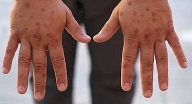 Maymun çiçeği virüsü hakkında bilinen yanlışlar
