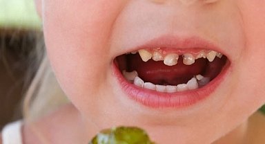 Okul çağındaki çocuklarda çürük riskine dikkat! Paketli gıdalar çocuk dişlerini vuruyor!