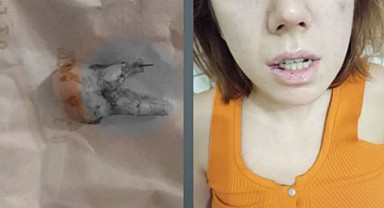 Kanal Tedavisinde Şok İddia