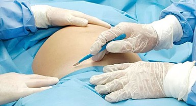 Sezaryen Sonrası Ölümde Doktor Serbest